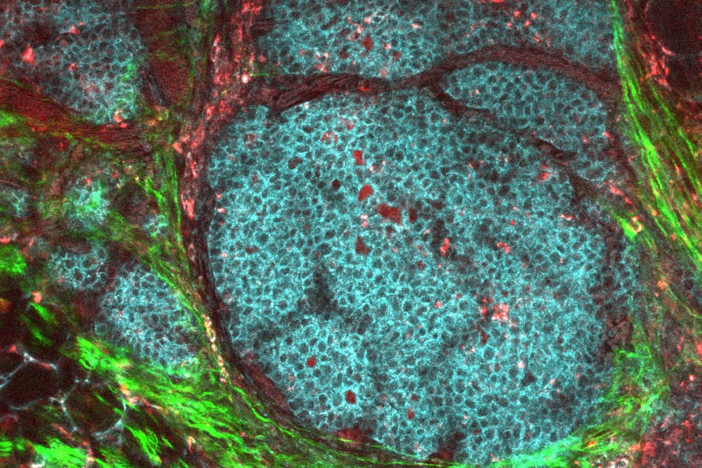 The Tumour Microenvironment