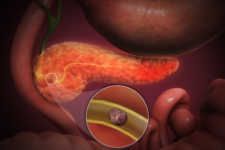 Exosome dominoes: How acute pancreatitis leads to lung injury