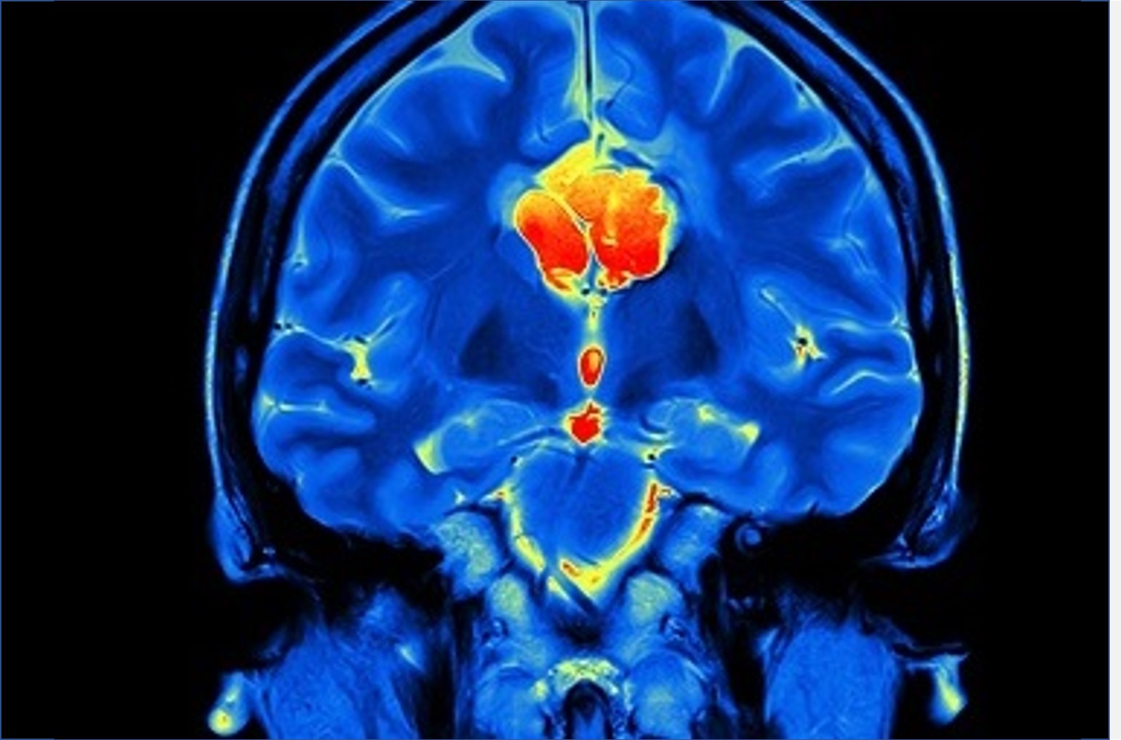 PeptiGel&reg; Alpha 2 in a model of intracerebral haemorrhage