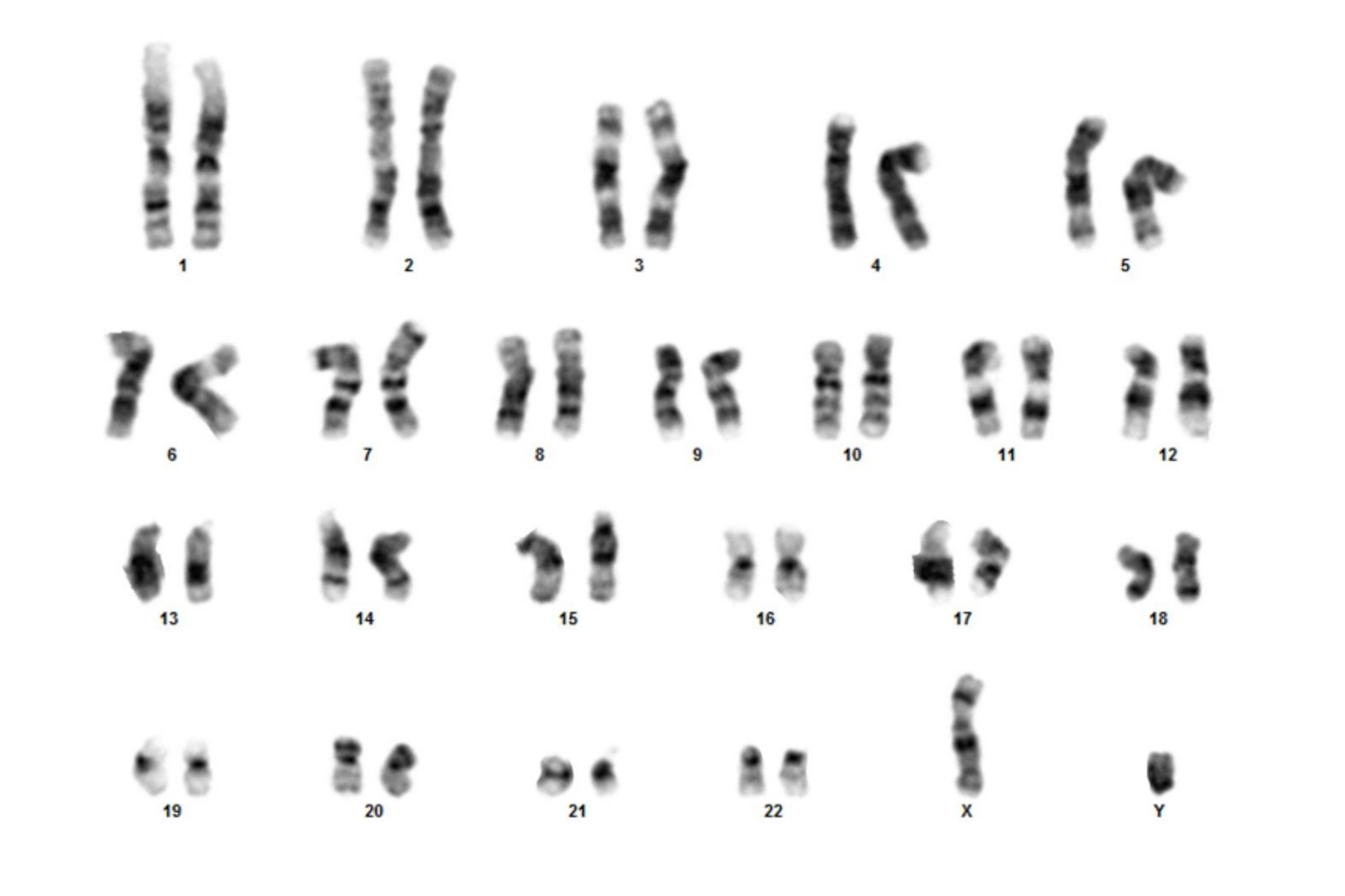 Xyy Syndrome Karyotype 46xyy Wellcome Collection