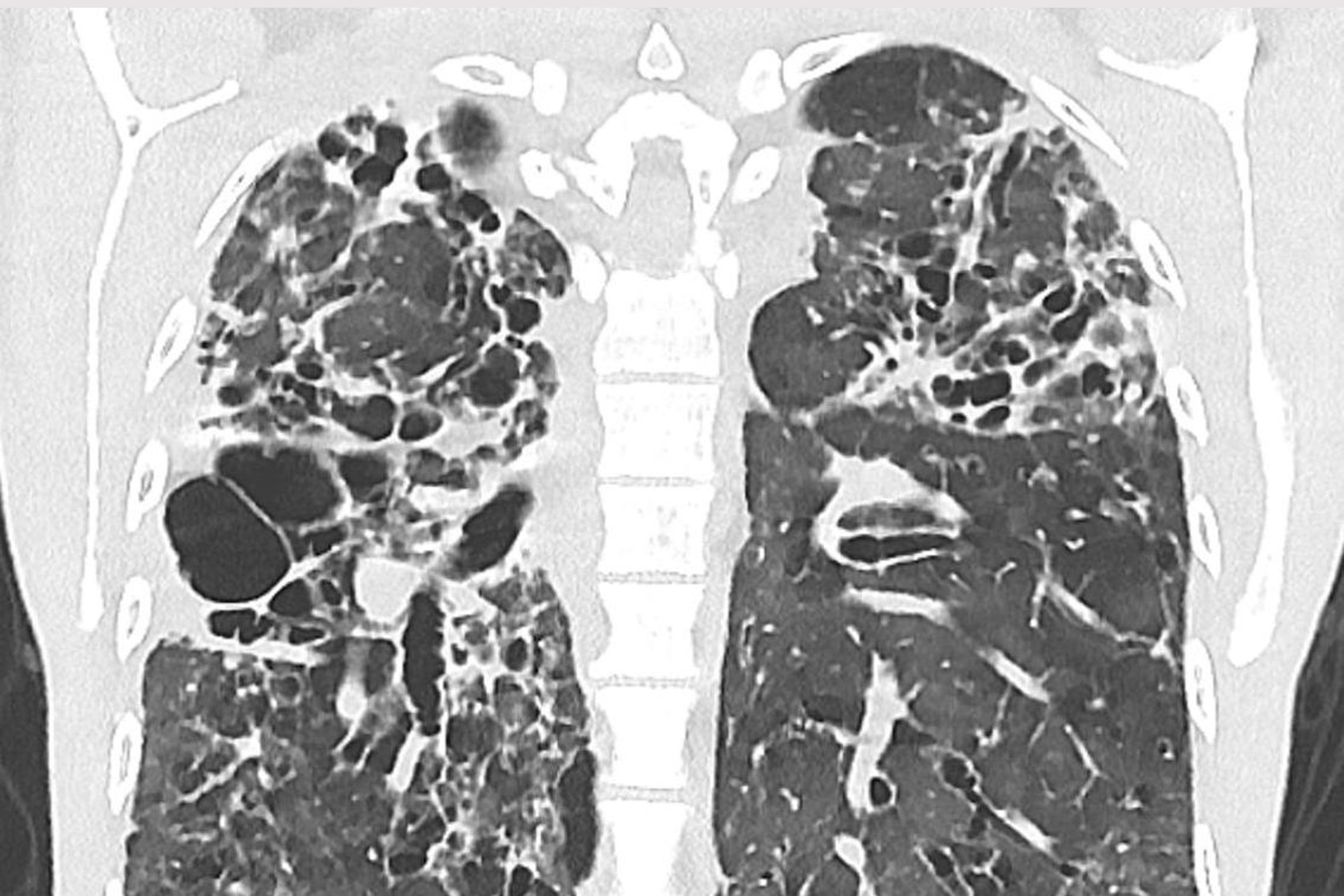 pulmonary fibrosis