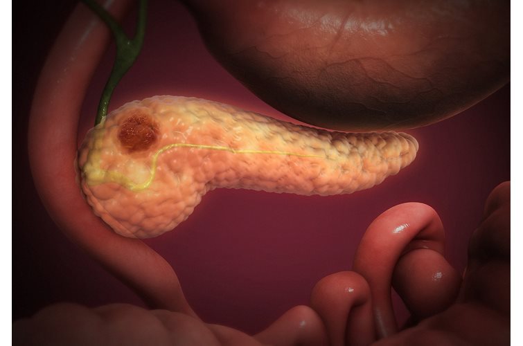 Organoids increasingly used to model pancreatic cancer