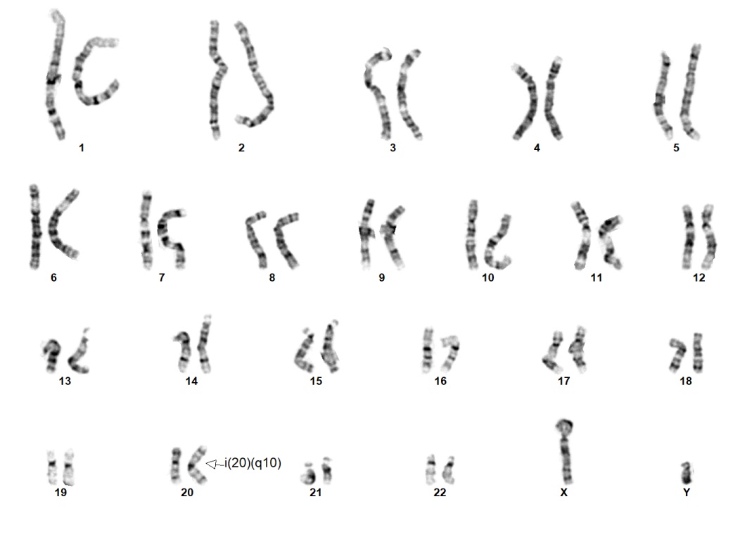 nondisjunction karyotype